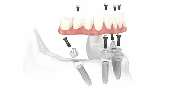 All on 4 Edgware - Dental Implants - Replacing missing teeth graphic